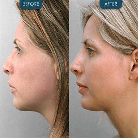 Chin Implant Before And After Zaren Clinic