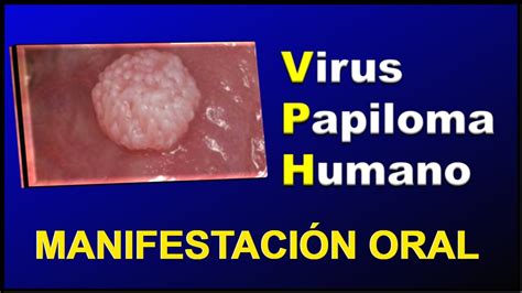 Top Imagenes De Virus Del Papiloma Humano Theplanetcomics Mx