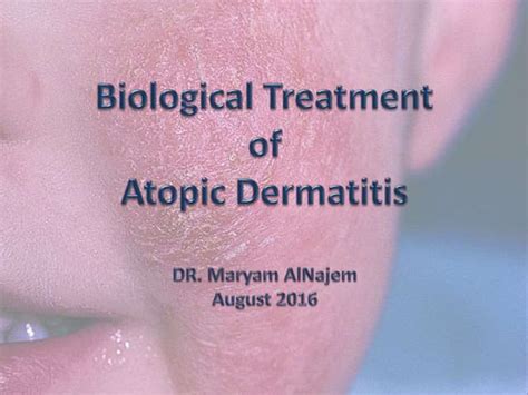 Atopic Dermatitis Understanding The Complex Genetic And Immunological