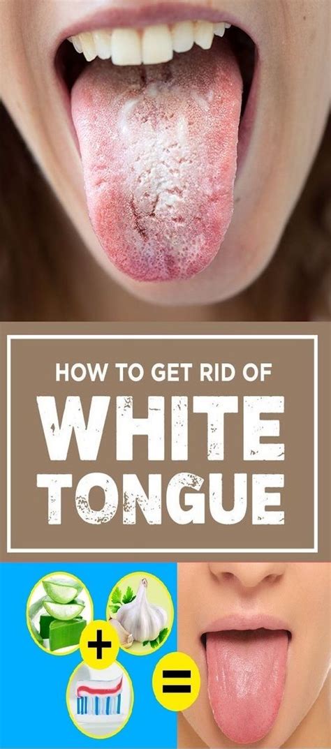 10 Ways To Get Rid Of White Tongue And Make It Healthier Health