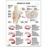 Photos of Torn Meniscus Home Remedies