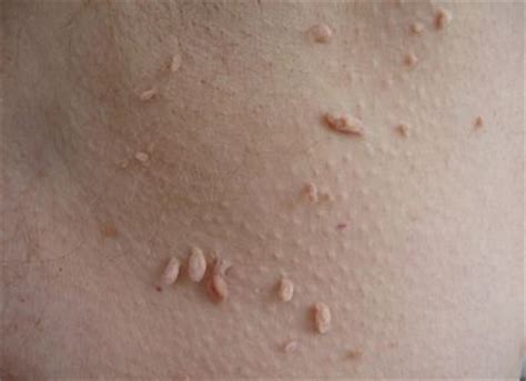 What causes campbell de morgan spots or blood spots? Treatment of skin lesions at BrightNewMe