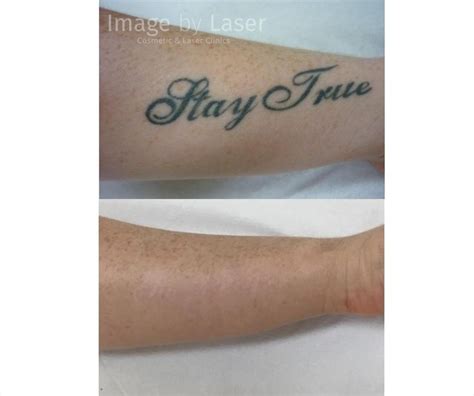 The problem is, many people tend to outgrow their tattoos as they develop and move through different life stages or simply change their mind. Laser Tattoo Removal Before & After Want amazing laser ...