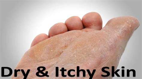 The Best Products For Dry Itchy Foot Skin The Best Home Treatment