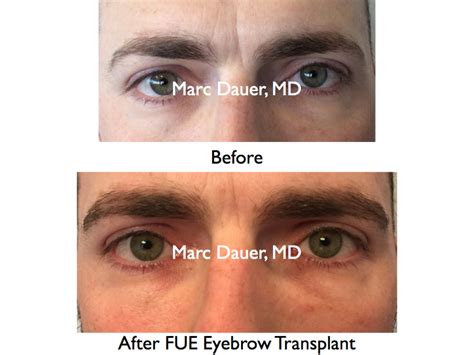 Hair Transplant Archives Eyebrow Transplant Los Angeles Marc Dauer Md