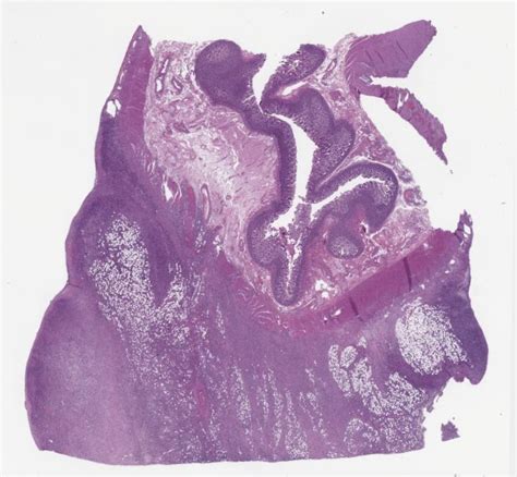 Diffuse Large B Cell Lymphoma With Anaplastic Features Involving The