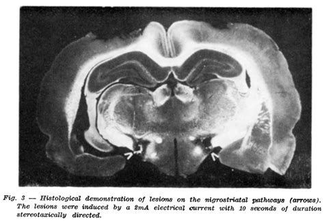 Histological Demonstration Of Lesions On The Nigrostriatal Pathways