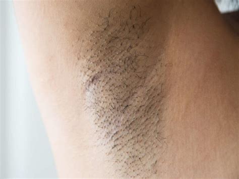 56 Hq Images Ingrown Hair Under Armpit With Lump Hidradenitis