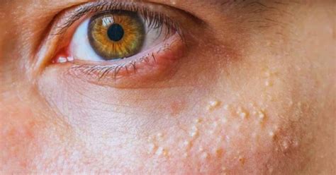 What Is Milialar A Complete Guide To This Skin Disease