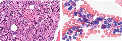 Histological Abnormalities Frequently Observed In Chronic Eosinophilic
