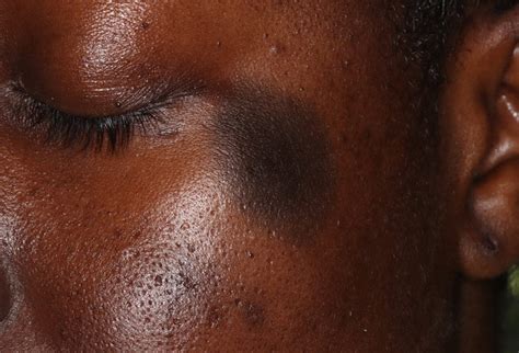 Identifying Lesions On Skin Of Color