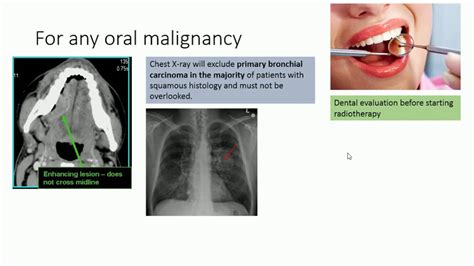Carcinoma Of Tongue Management Of Stage 1 Youtube