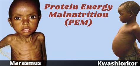 Protein Energy Malnutrition Pem Marasmus And Kwashiorkor