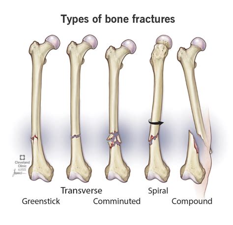 Spiral Fracture Symptoms Causes And Treatment