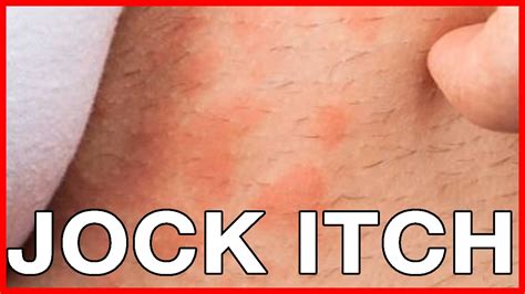 Jock Itch Causes Of Jock Itch In Women Or Female Treatment