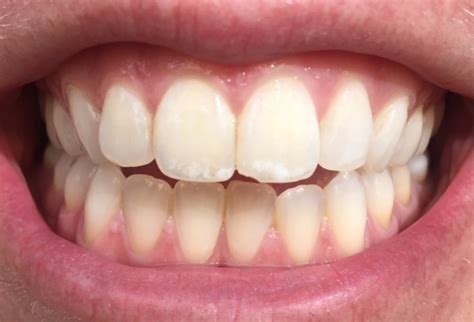 White Spots On Teeth Rvindicta