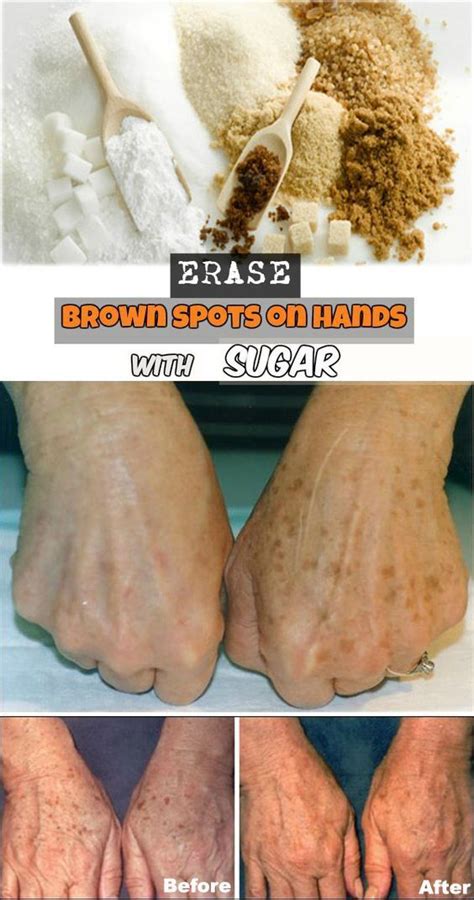Erase Brown Spots On Hands With Sugar Brown Spots On Hands Brown