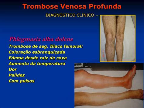 Ppt Trombosis Venosa Profunda Powerpoint Presentation Free To View