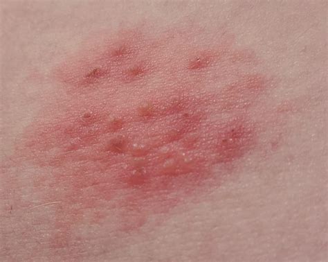 First Signs Of Shingles On Stomach