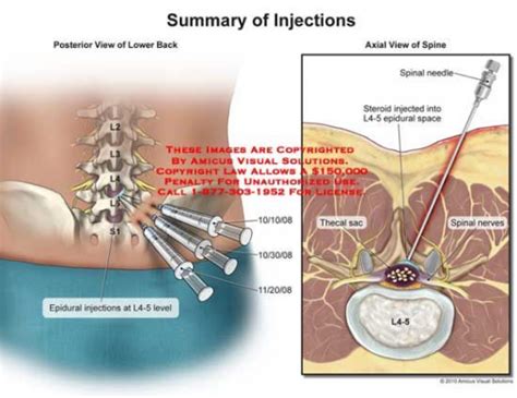 Lower Back Injection Of Steroids A Medical Image Showing The Internal