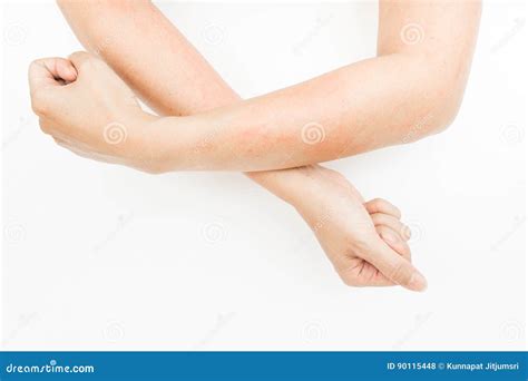 Rash Allergy From Touching Arms Eczema Dermatitis Stock Photo Image