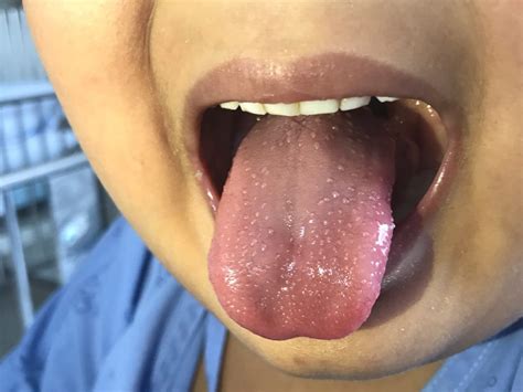 Is It Normal To Have Bumps On Back Of Tongue Know It Here