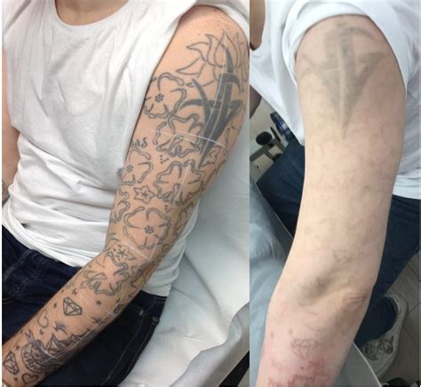 City Tattoo Removal Never Too Late To Start Again — Mens Style Blog