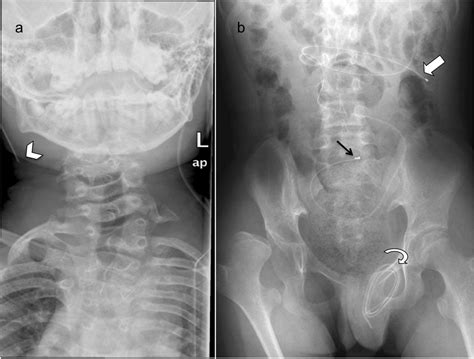 Migration Of A Fractured Ventriculoperitoneal Shunt Into The Scrotum A Rare Complication Bmj