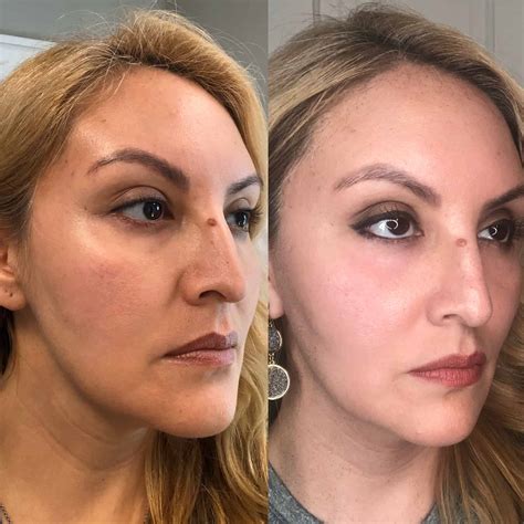 Halo Laser Treatment Before And After Photos Fresh Face Eye