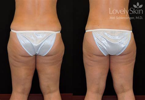 Omaha Cosmetic Surgery Tumescent Liposuction Skin Specialists Pc