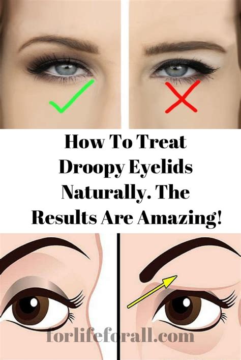 How To Treat Droopy Eyelids Naturally The Results Are Amazing For