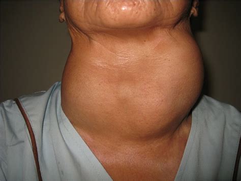 17 Effective Home Remedies For Goiter Health Tips