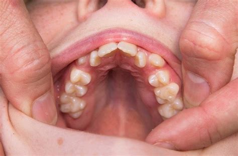 Dentofacial Orthopedics Southbridge Ma Headgear Pediatric Orthodontics