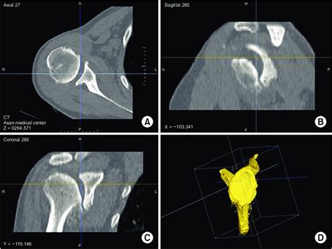 Axial A Sagittal B And Coronal C Computed Tomographic Images