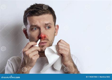 Young Man With A Red Nose Has Allergies Stock Photo Image Of Medical