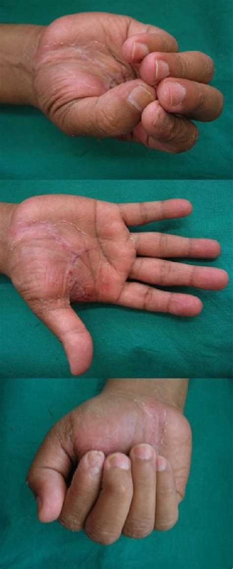 Figure 5 From A Giant Lipoma In The Hand Report Of A Rare Case