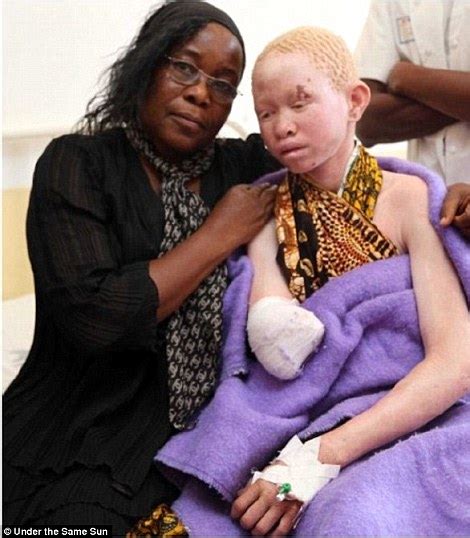 Tanzanias Albinos Relive Horror Of Their Limbs Being Stolen By