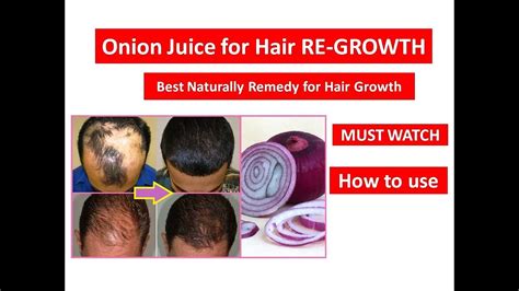recipes included onion juice is the perfect natural solution for hair loss as it promotes growth and hair regeneration. !! ONION JUICE !! for HAIR REGROWTH before-after | STOP ...