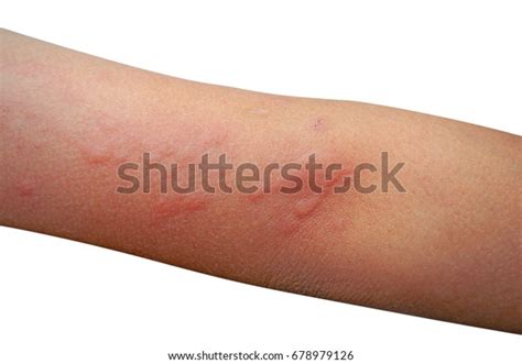 Urticaria On Hand Stock Photo 678979126 Shutterstock