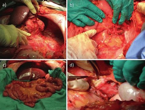 The stomach, gallbladder, and pancreas are three of the most important digestive organs in the human body. Multivisceral (en bloc liver, stomach, pancreas, and small intestine)... | Download Scientific ...