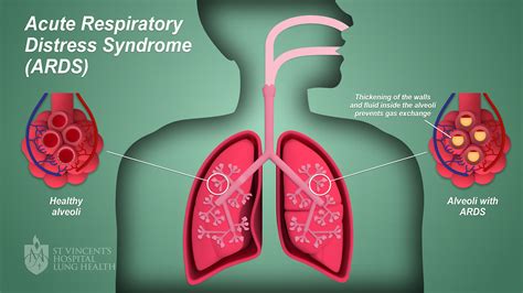 Mechanism Of Acute Respiratory Distress Syndrome Ards In The Alveoli