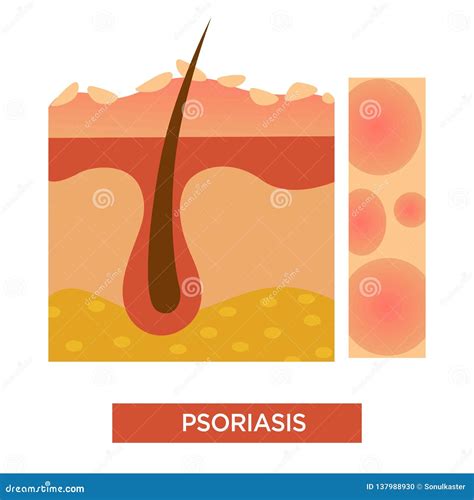 Psoriasis Skin Disease Or Illness Dermatology Vector Illustration Stock