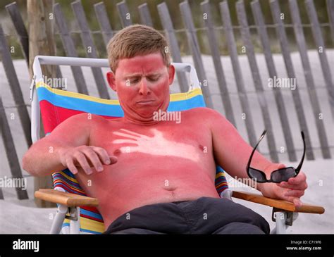 A Model Looks To Be Badly Sunburned After Falling Asleep On The Stock