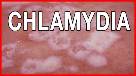 Signs And Symptoms Of Chlamydia How To Treat Chlamydia In Women And Men Youtube