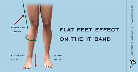 The Effect Of Flat Feet On The It Band Mass4d Foot Orthotics