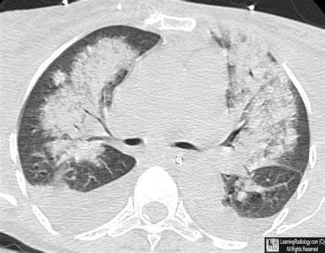 Learning Radiology Congestive Heart Failure Pulmonary Edema