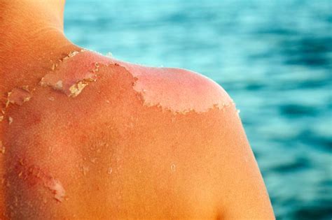 How Long Does A Sunburn Last—and Is There Any Way To Make It Heal Faster