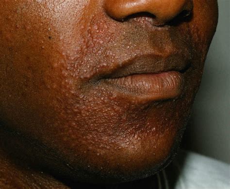 Childhood Granulomatous Periorificial Dermatitis Syn Facial Afro
