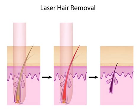 Since it specifically works on heating up the melanin in your hair, it does not have any effect on the surrounding skin. Laser Hair Removal at Home - Home Laser Hair Removal