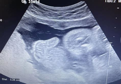 Ultrasound Image Showing The Mass Protruding From The Anterior